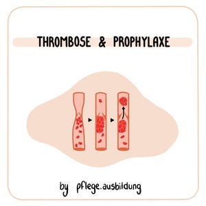 Puede incluir: Ilustración que muestra la formación de un coágulo de sangre en una vena. La imagen muestra tres etapas de la formación de un coágulo de sangre, con glóbulos rojos que se aglutinan. El texto "THROMBOSE & PROPHYLAXE" está en la parte superior de la imagen. El texto "by pflege.ausbildung" está en la parte inferior de la imagen.