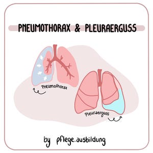 Könnte beinhalten: Anatomische Illustration der Lunge, die Pneumothorax und Pleuraerguss darstellt. Die Lungen sind rosa, wobei die Pneumothorax-Seite blau und weiß und die Pleuraerguss-Seite blau ist. Text: "Pneumothorax & Pleuraerguss" und "by pflege.ausbildung."