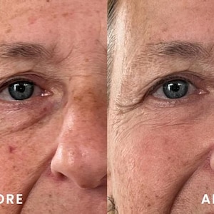 Peut inclure: Image divis&eacute;e montrant un visage comparatif, avec les mentions "AVANT" et "APR&Egrave;S". Le c&ocirc;t&eacute; "AVANT" pr&eacute;sente des rides et imperfections cutan&eacute;es. Le c&ocirc;t&eacute; "APR&Egrave;S" r&eacute;v&egrave;le un teint plus lisse avec moins de rides, sugg&eacute;rant l'effet d'un produit ou traitement de soin.