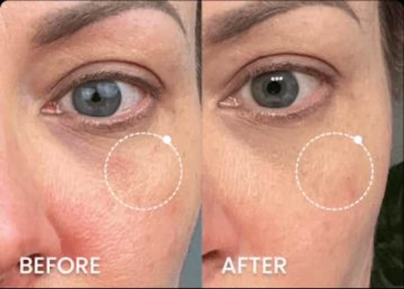 Peut inclure: Une image divis&eacute;e montre un gros plan du visage d'une personne, avec le c&ocirc;t&eacute; gauche &eacute;tiquet&eacute; "AVANT" et le c&ocirc;t&eacute; droit &eacute;tiquet&eacute; "APR&Egrave;S". Le c&ocirc;t&eacute; "AVANT" montre des rougeurs et des imperfections, tandis que le c&ocirc;t&eacute; "APR&Egrave;S" appara&icirc;t plus lisse et plus uniforme.