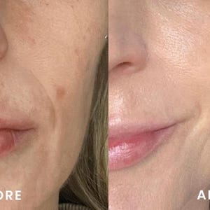 Peut inclure: Image divis&eacute;e en deux parties, montrant un visage en gros plan. Le c&ocirc;t&eacute; gauche, intitul&eacute; "AVANT", pr&eacute;sente une peau avec des imperfections. Le c&ocirc;t&eacute; droit, intitul&eacute; "APR&Egrave;S", montre une peau plus lisse, sugg&eacute;rant un produit de soin.