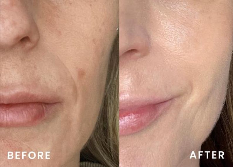 Peut inclure: Image divis&eacute;e en deux parties, montrant un visage en gros plan. Le c&ocirc;t&eacute; gauche, intitul&eacute; "AVANT", pr&eacute;sente une peau avec des imperfections. Le c&ocirc;t&eacute; droit, intitul&eacute; "APR&Egrave;S", montre une peau plus lisse, sugg&eacute;rant un produit de soin.