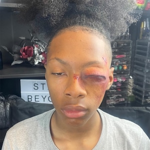 Swollen Eye Prosthetics | SFX Makeup