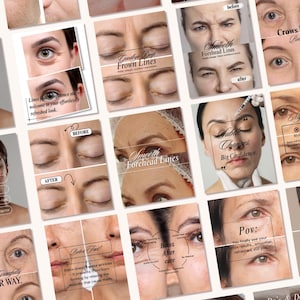 May include: A collection of images showcasing before and after comparisons of cosmetic procedures. The images feature close-ups of eyes and faces, with text overlays highlighting the effects of treatments like Botox and addressing topics like frown lines and crows feet.