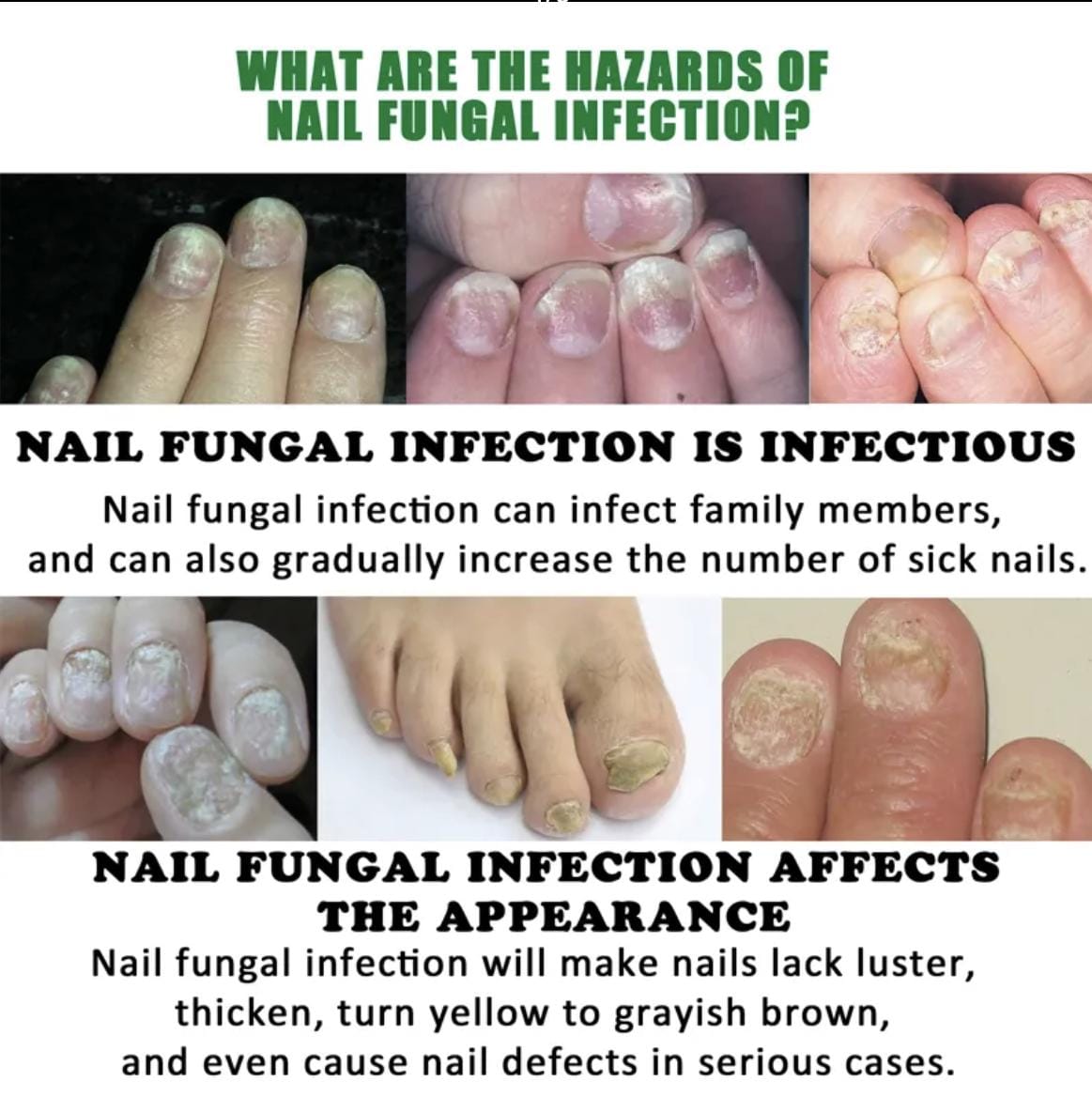 7 Day Nail Fungus Treatment and Cuticle Repair Oil Strengthens and