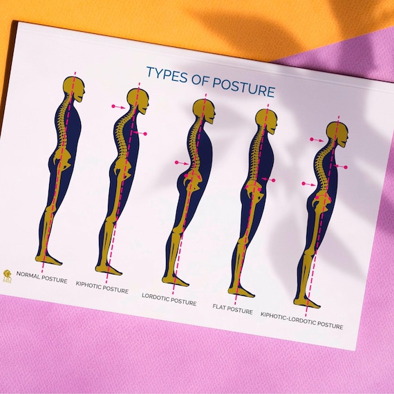 Types of Posture Anatomy Poster A2 Size Digital Download Postural Assessment Wall Chart Physiotherapy & Pilates Printable