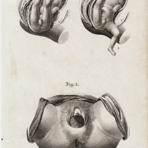 MATURE 1840 Antique FETUS print, fine anatomy engraving of parturition, Pregnancy, obstetrics for midwives,