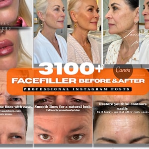 Medspa Instagram Templates: Dermal Filler Before & After (Canva Editable, 3100+ Posts) (Digital Download