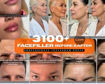 3100+Dermal Filler Instagram Template: Face filler injection before and after, Botox canva template,Medspa social media, nurse injector