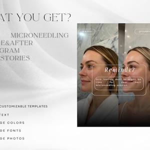 K&ouml;nnte beinhalten: Werbung f&uuml;r Microneedling-Instagram-Posts und -Stories. Das Bild zeigt einen Vorher-Nachher-Vergleich der Haut einer Person. Der Text enth&auml;lt "What You Get?" und "Reminder" mit Details zum Service, einschlie&szlig;lich anpassbarer Vorlagen.