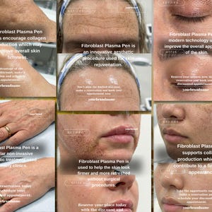 Op de afbeelding: Een collage van afbeeldingen die de Fibroblast Plasma Pen-behandeling laten zien. De afbeeldingen tonen voor- en na-resultaten op de huid, met tekst die de collageenproductie en huidverjonging benadrukt. De tekst bevat de merknaam en moedigt aan tot het boeken van afspraken.