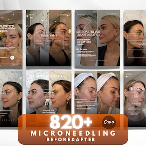 K&ouml;nnte beinhalten: Eine Collage von Vorher-Nachher-Bildern, die die Auswirkungen von Microneedling-Behandlungen zeigen. Die Bilder zeigen das Gesicht einer Frau und heben Hautverbesserungen hervor. Text enth&auml;lt "Microneedling Transformation" und "820+ Microneedling Before & After."