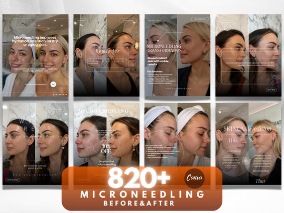 Microneedling Instagram Canva Template: Skincare Before & After Posts