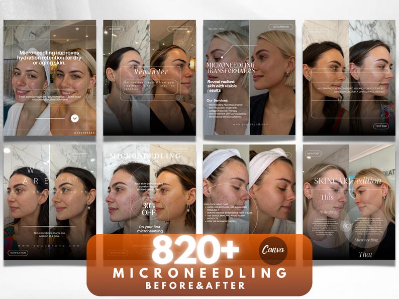 K&ouml;nnte beinhalten: Eine Collage von Vorher-Nachher-Bildern, die die Auswirkungen von Microneedling-Behandlungen zeigen. Die Bilder zeigen das Gesicht einer Frau und heben Hautverbesserungen hervor. Text enth&auml;lt "Microneedling Transformation" und "820+ Microneedling Before & After."