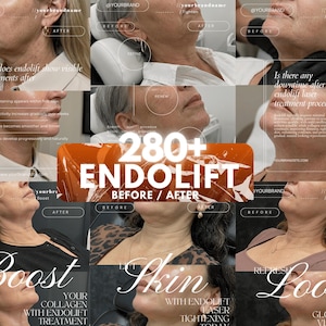 May include: A collage of before and after images showcasing facial and neck skin improvements from endolift laser treatments. The text includes 280+ ENDOLIFT BEFORE / AFTER, Boost Your Collagen, Lift Skin, and Refresh Look, alongside informational text about procedure downtime and results.