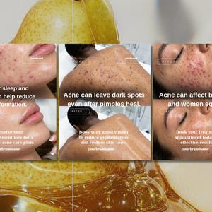 May include: A promotional image for acne treatment featuring before and after photos. The text highlights the benefits of proper sleep, hydration, and treatment for acne, dark spots, and skin tone. The image includes the brand name and a call to action.