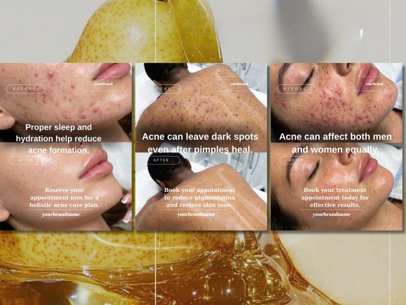 May include: A promotional image for acne treatment featuring before and after photos. The text highlights the benefits of proper sleep, hydration, and treatment for acne, dark spots, and skin tone. The image includes the brand name and a call to action.