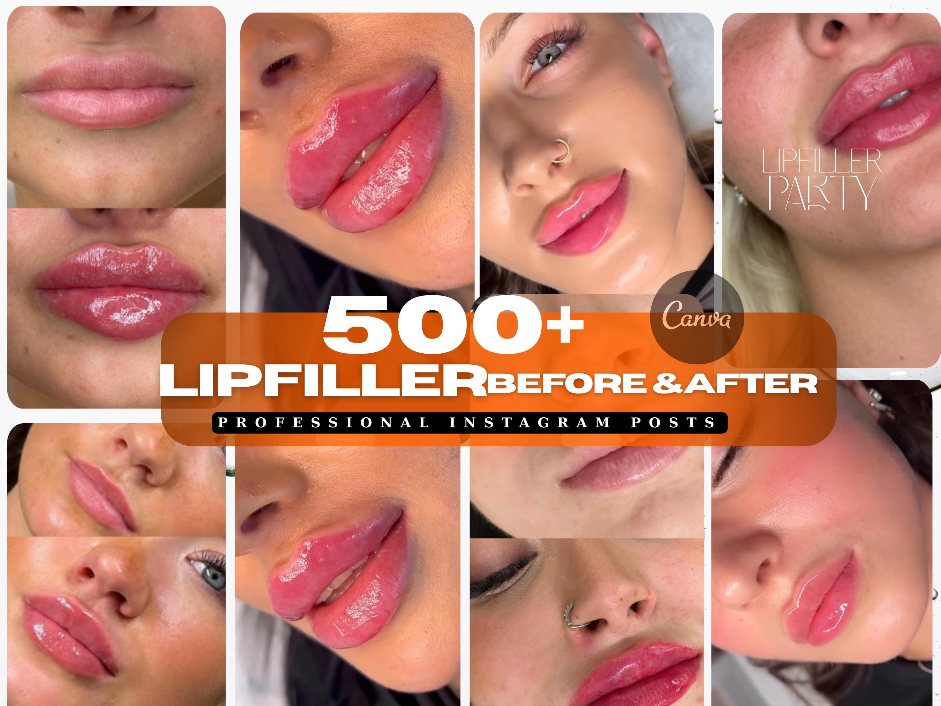 Lip Filler Before After Post | Lip Injection Before and After