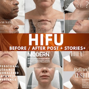 Pode incluir: Uma colagem de imagens mostrando indivíduos recebendo tratamentos de pele HIFU. O texto central diz HIFU BEFORE / AFTER POST + STORIES+ MODERN. O texto adicional inclui PROFESSIONAL GUIDANCE PERSONALIZED AESTHETIC EXPERIENCE e Refined Body AESTHETICS.
