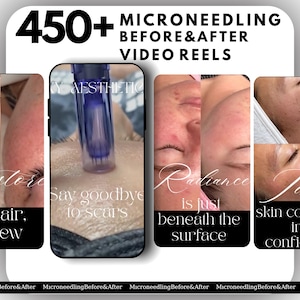 Microneedling Video Reels Template: Esthetician Marketing (Canva)
