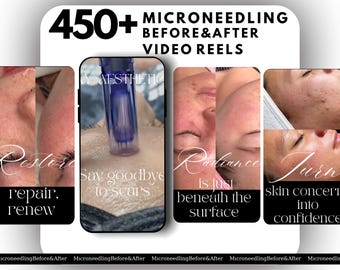 Microneedling before after video Reels | Esthetician  Template | Facial Treatment Template | Microneedling template| RF Microneedling Reels
