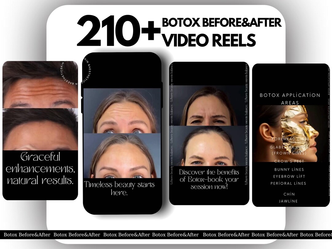 Botox| Botox Before and After | Botox Instagram Posts | Skincare ...