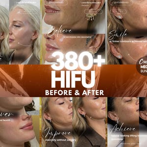May include: A collage of before and after images showcasing facial rejuvenation results. The images feature the text "380+ HIFU BEFORE & AFTER" and other text such as "Radiate", "Believe", "Smile", "Uncover", "Improve", and "Achieve".