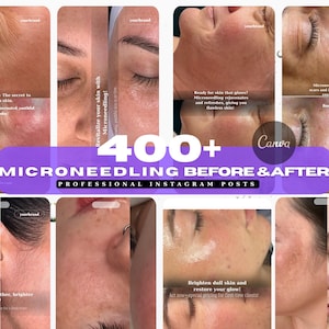 Microneedling Instagram Templates: Esthetician & Medspa Canva Posts (Digital Download)