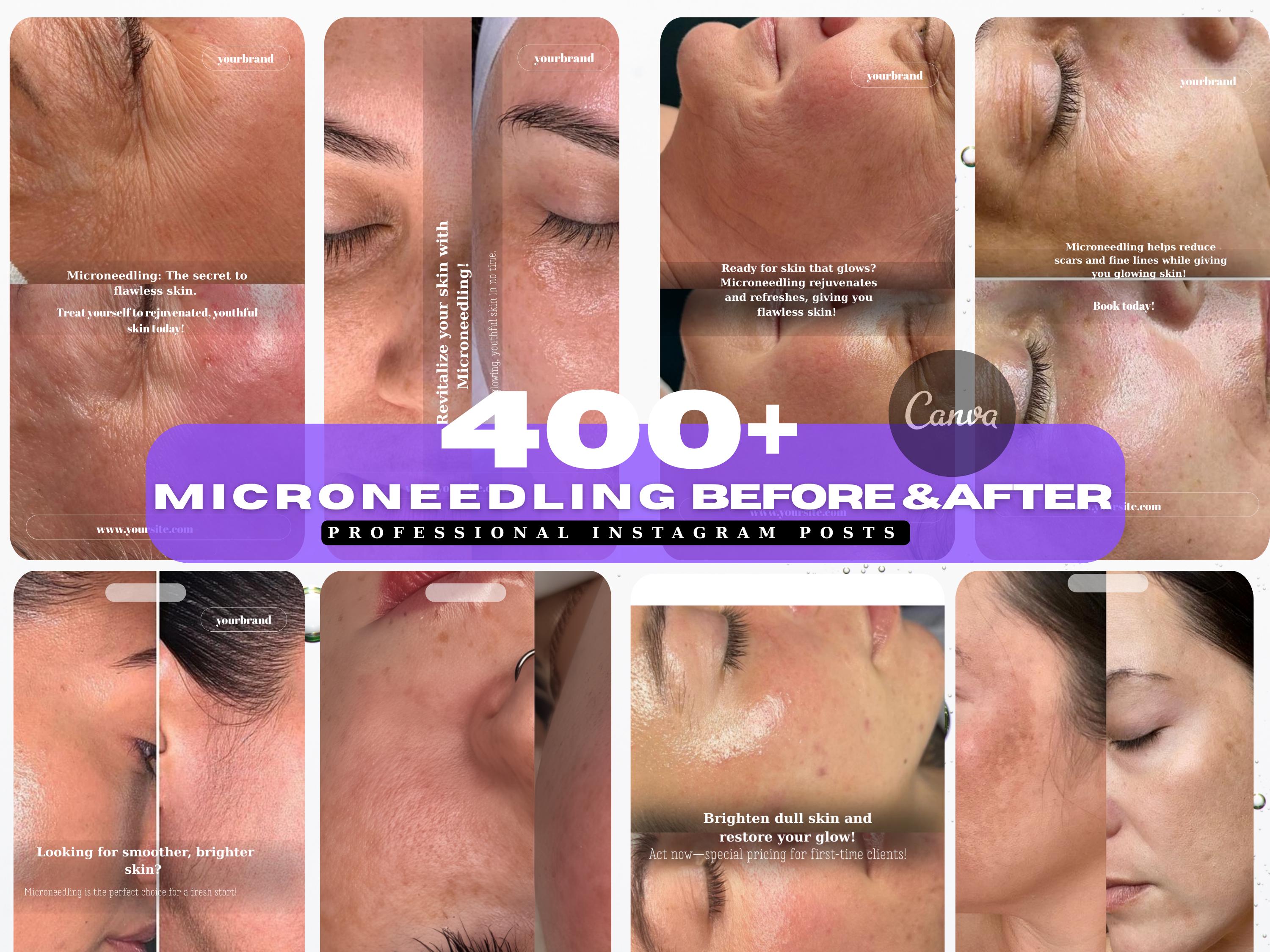Microneedling before after | Esthetician Instagram Template | Facial Treatment Template | Microneedling template | RF Microneedling Posts