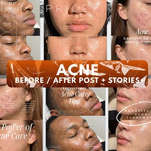 May include: A collage of close-up facial images showing skin with acne and clear skin, featuring text overlays including Acne causes, Price, Acne is a common skin condition, Nighttime Acne Care Tips, and The Power of Acne Care.
