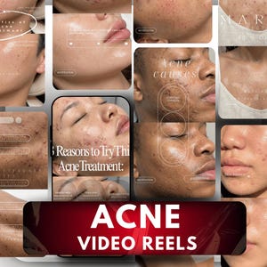 May include: A digital collage of video reels featuring various individuals with visible acne, accompanied by text overlays including "Benefits of acne treatment," "Acne causes," "5 Reasons to Try This Acne Treatment," and "ACNE VIDEO REELS" in bold white font.