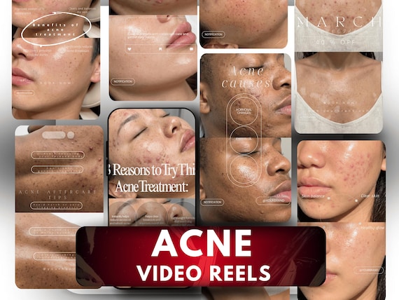 Acne Before After Reels Video | Medspa Skincare Canva Template