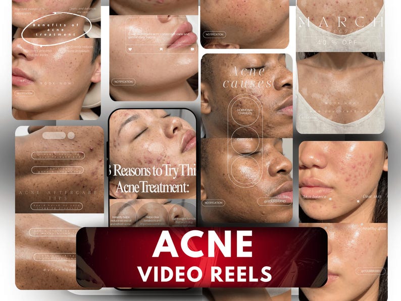May include: A digital collage of video reels featuring various individuals with visible acne, accompanied by text overlays including "Benefits of acne treatment," "Acne causes," "5 Reasons to Try This Acne Treatment," and "ACNE VIDEO REELS" in bold white font.