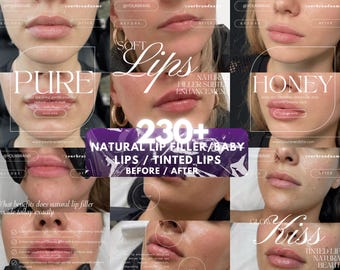 Lip Filler Before & After Instagram Templates Canva Editable | Aesthetic Injector Medspa Social Media Kit | Cosmetic Clinic Branding Posts