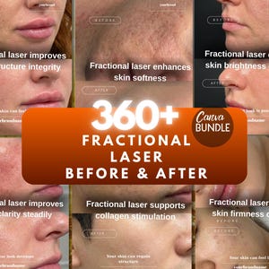 May include: A collage showcasing the effects of fractional laser treatments on skin. The image features before and after photos, highlighting improvements in skin structure, clarity, softness, and firmness. The text reads "360+ Fractional Laser Before & After".