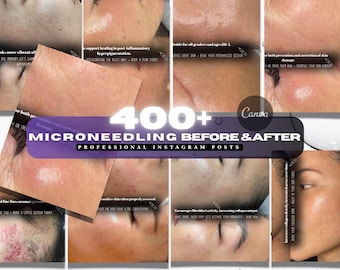 Microneedling Instagram Beiträge | Microneedling vor und nach | Hautpflege | Microneedling-Leinwand, Microneedling-Ergebnis