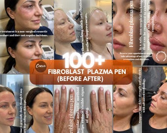 Canva-mall för fibroblastbehandling | Instagram-inlägg för hudåtstramning | Redigerbara sociala medier för plasmalyftning | Marknadsföringskit för estetisk klinik