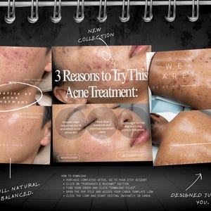 May include: A digital marketing template for acne treatment featuring multiple close-up photographs of skin showing before and after results. The text includes "3 Reasons to Try This Acne Treatment:" and "Benefits of acne treatment" with instructions on how to download the file from Etsy.