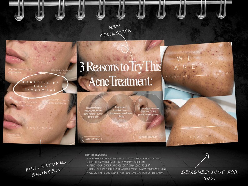May include: A digital marketing template for acne treatment featuring multiple close-up photographs of skin showing before and after results. The text includes "3 Reasons to Try This Acne Treatment:" and "Benefits of acne treatment" with instructions on how to download the file from Etsy.