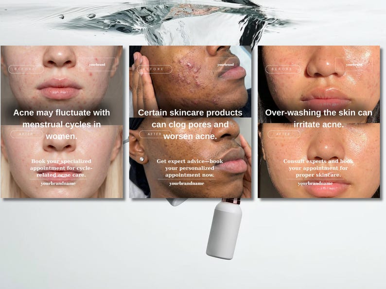 May include: A skincare product advertisement featuring close-up images of faces with acne. Text highlights factors that can affect skin, including menstrual cycles and over-washing. A white bottle is also visible.