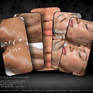 May include: A set of digital social media templates for skincare featuring close-up photography of skin with acne. The designs include text overlays such as acne care, 3 Reasons, and numbered lists. The templates are displayed on smartphone screens.