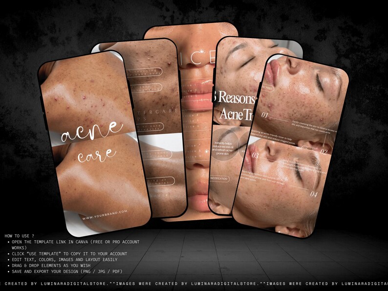 May include: A set of digital social media templates for skincare featuring close-up photography of skin with acne. The designs include text overlays such as acne care, 3 Reasons, and numbered lists. The templates are displayed on smartphone screens.