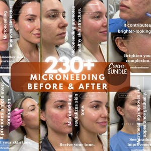 Microneedling före- och eftermall | Redigerbart Instagram-inlägg | Digital nedladdning av Canva-mall
