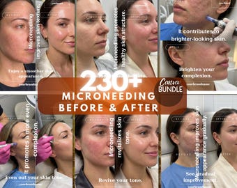 Microneedling Vorher & Nachher Ergebnisse | Hautpflege Transformation | Bearbeitbarer Instagram Post | Digital Download Canva Vorlage