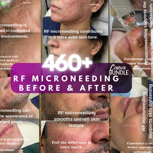 RF Microneedling Canva-mall | Före-efter-hudinlägg | Estetisk klinik Instagram | Redigerbar digital nedladdning