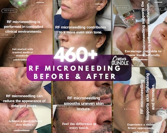 RF Microneedling Canva Template | Vorher Nachher Hautpflege | Ästhetische Klinik Instagram | Bearbeitbarer digitaler Download