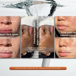 May include: A promotional image showing before and after photos of skin affected by acne. The text highlights the benefits of skincare routines, including reducing dark spots and acne scars. The brand name is also visible.