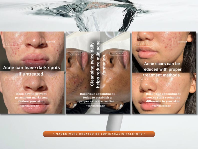 May include: A promotional image showing before and after photos of skin affected by acne. The text highlights the benefits of skincare routines, including reducing dark spots and acne scars. The brand name is also visible.