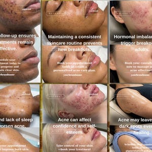 May include: A collage of images showing skin before and after acne treatments. The text highlights the importance of follow-up, skincare routines, and managing acne. It also mentions stress, sleep, and hormonal imbalances.