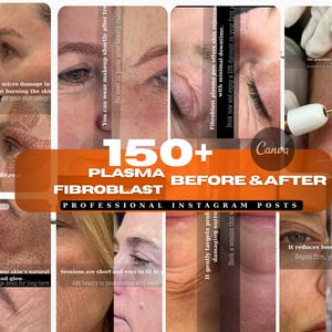 May include: A collage of before and after photos showing the results of plasma fibroblast treatment. The text "150+ Plasma Before & After Fibroblast Professional Instagram Posts" is displayed in the centre of the image.